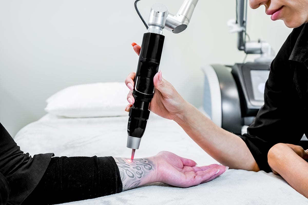 Laser tattoo removal of a large tattoo on a patient’s arm, using picosecond laser technology, in a beauty and medical laser clinic. Technician is holding the hand piece.