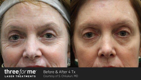 ThreeForMe-Before-&-After—6