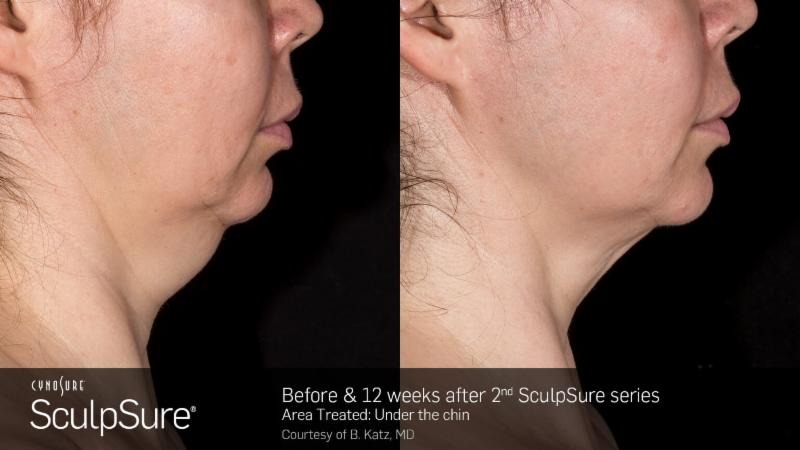 Get Ready for Summer With SculpSure Body Contouring
